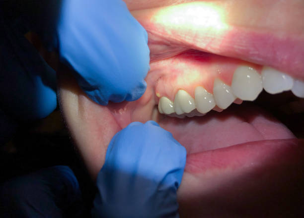 Best Emergency Wisdom Tooth Extraction in Dalton, GA