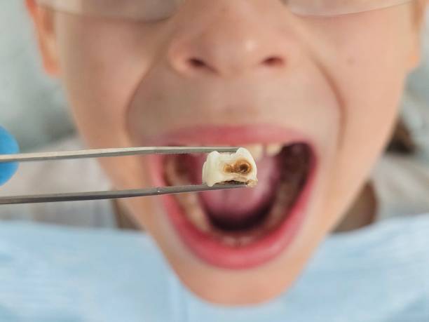 Best Emergency Treatment for Oral Infections in Dalton, GA